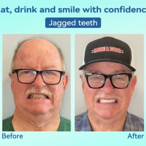 Tiworld®, Premium Denture, flexible dentures