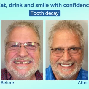 Tiworld®, Premium Denture, flexible dentures