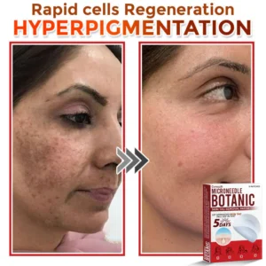 Cvreoz® MicroNeedle Botanic Skin Tag Removal Patch