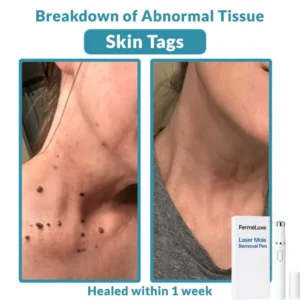 FerméLuxe Wart Removal Laser Pen