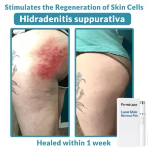 FerméLuxe Wart Removal Laser Pen