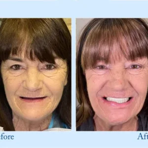 Hidone®Advanced Denture Kit with Custom Dentures