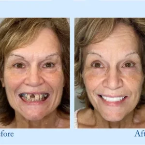 Hidone®Advanced Denture Kit with Custom Dentures