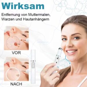 Hermsa® non-invasive laser pointer - mole and wart removal