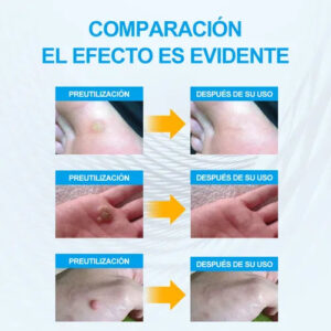 FORMU CLEAR™ Painless Wart-Free Skin! 216 Patches!