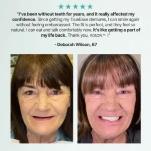 ROSOPL™ Custom-fit, fully functional dentures