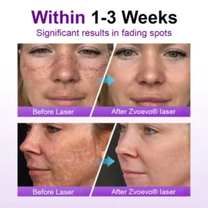 Alisanda® SpotErase Probiotic Shield Serum