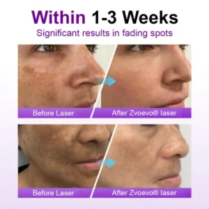 Alisanda® SpotErase Probiotic Shield Serum