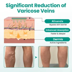 Alisanda® Varicose Veins Patch