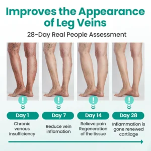 Alisanda® Varicose Veins Patch