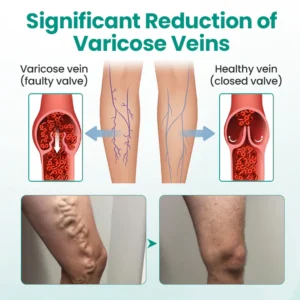 Alisanda® Varicose Veins Patch