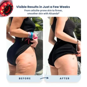 Alisanda® – Firmer, More Toned Skin