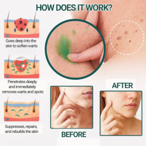 Alisanda® gel | Clinically proven to remove 95%